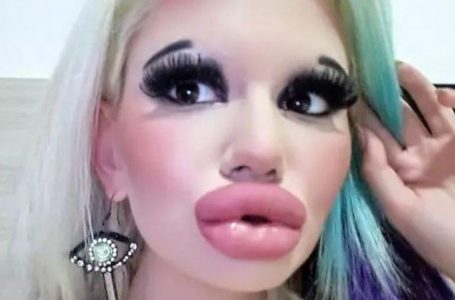 Mujer se somete a más de 15 cirugías para tener los labios perfectos