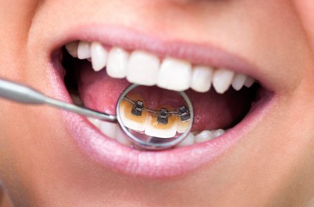 Ortodoncia: ¿Cuándo usar frenillos?